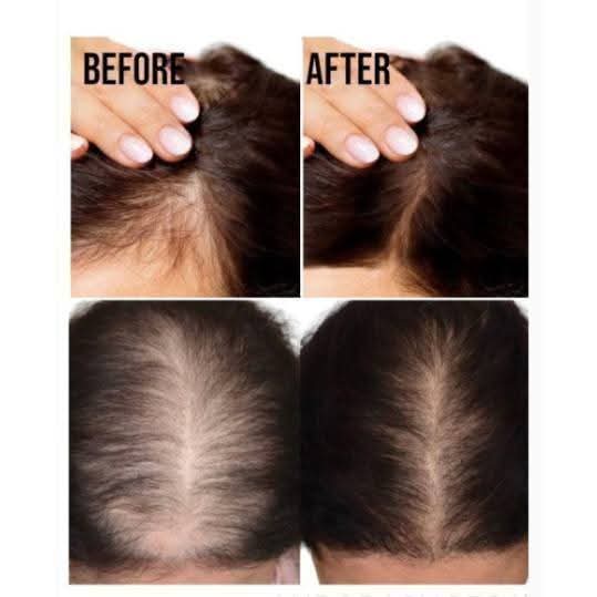 MINOXY PLUS hair spray 60ml | Minoxidil serum