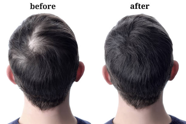 MINOXY PLUS hair spray 60ml | Minoxidil serum